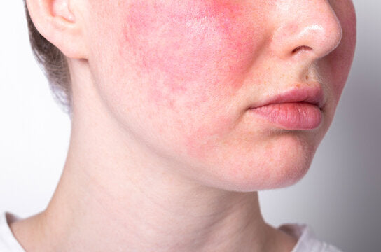 Demystifying Rosacea