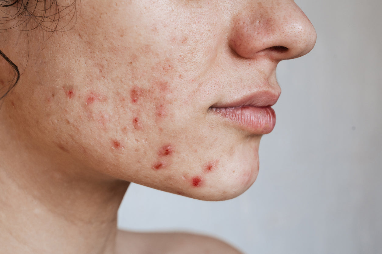 Face Acne: Causes, Symptoms and Treatment